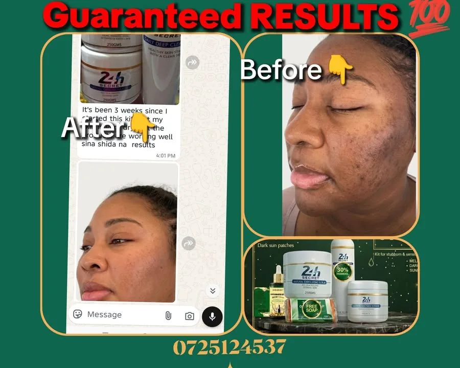 24HR SECRET client result — Hapa napo tumeweza Another happy client Acne + Dark Hyperpigmentation We only post clients who have given us permission to share their progress Real results.