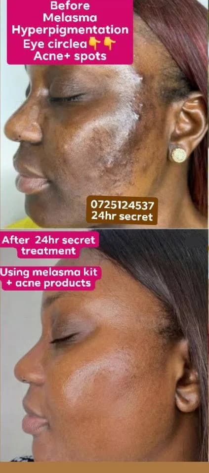 24HR SECRET client result — Client Testimonial MELASMA SUNBURNS DARK PATCHES " She had struggled with stubborn melasma and deep hyperpigmentation for years.
