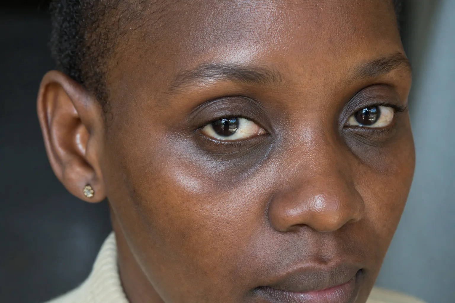 Close-up showing pigmented dark circles under the eye of a Black African person with deep brown skin